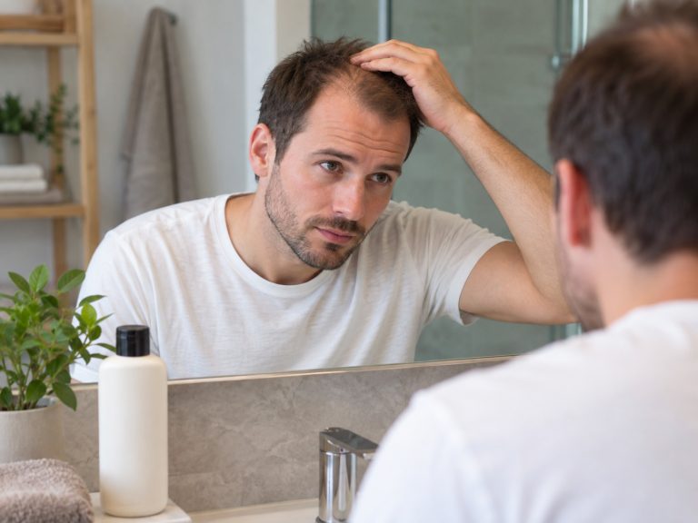 Uomo che osserva i capelli allo specchio in una routine dedicata all’alopecia androgenetica